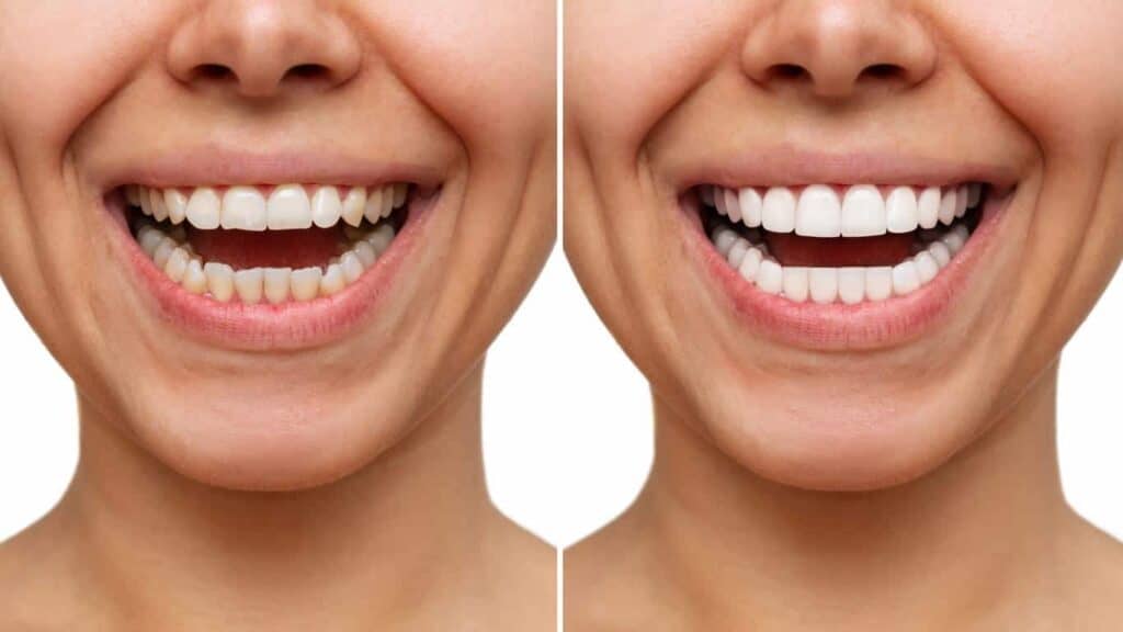 Steps to prepare your teeth for whitening and reduce tooth sensitivity risks.