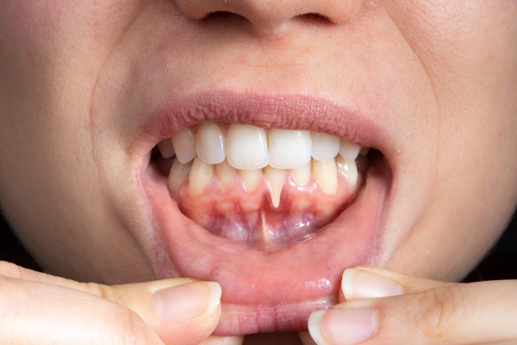 Preparing for teeth whitening with receding gums Stockport