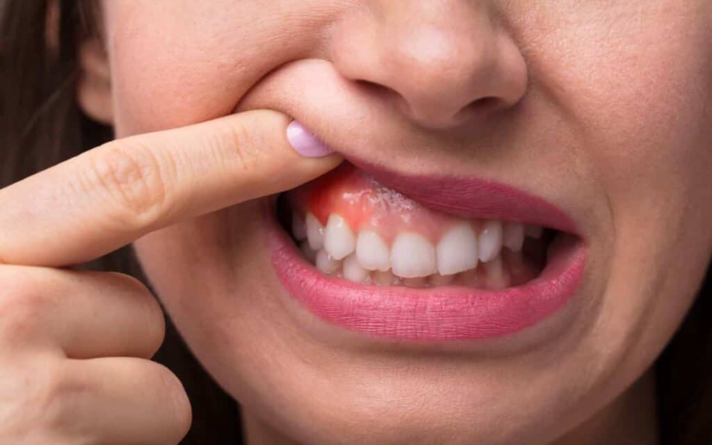 What is Receding Gums Stockport?