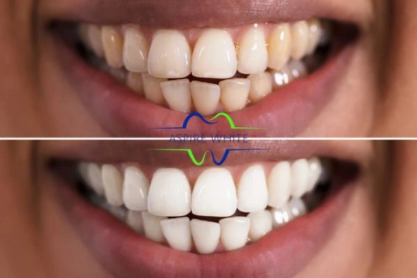 Aspire White customer before and after Stockport results.