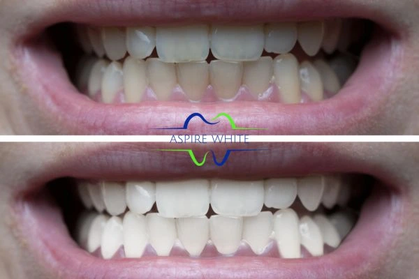 1 hour laser teeth whitening before and after results Stockport