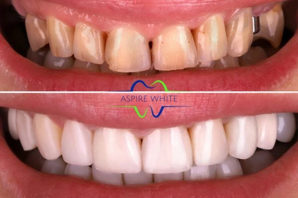 Yellow teeth results - 1 hour whitening before and after results Stockport
