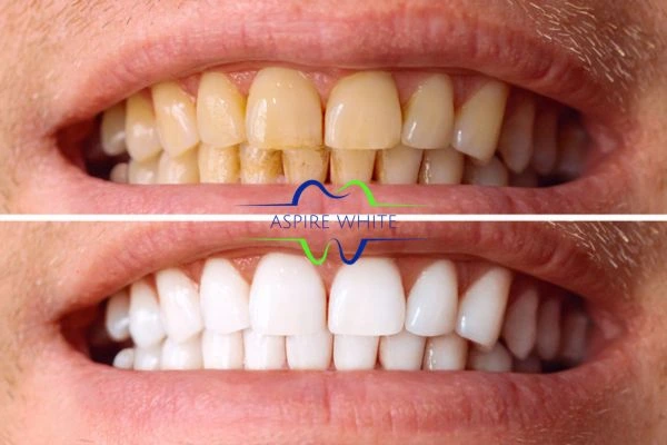 Get noticeable whiter smile in just one hour! Book your teeth whitening treatment Stockport today!