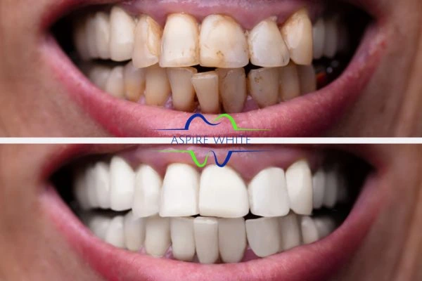 Before and after results of laser teeth whitening Stockport Book in online today!
