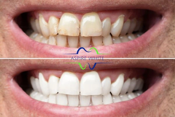 Achieve a radiant smile with professional laser teeth whitening Stockport
